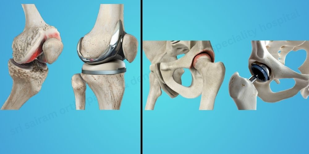 Joint Replacement Sri Sai Ram ORthopedic