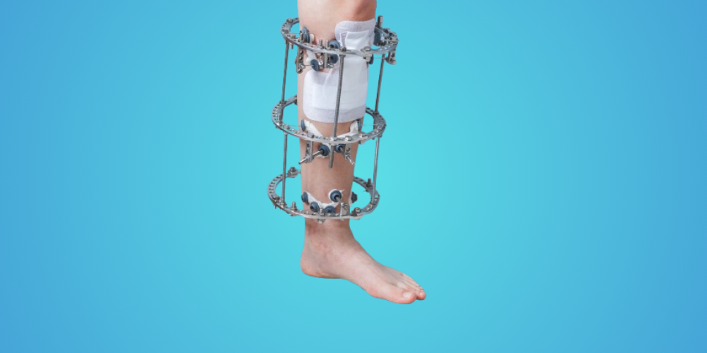 Ilizarov surgery Sri Sai Ram Orthopedic